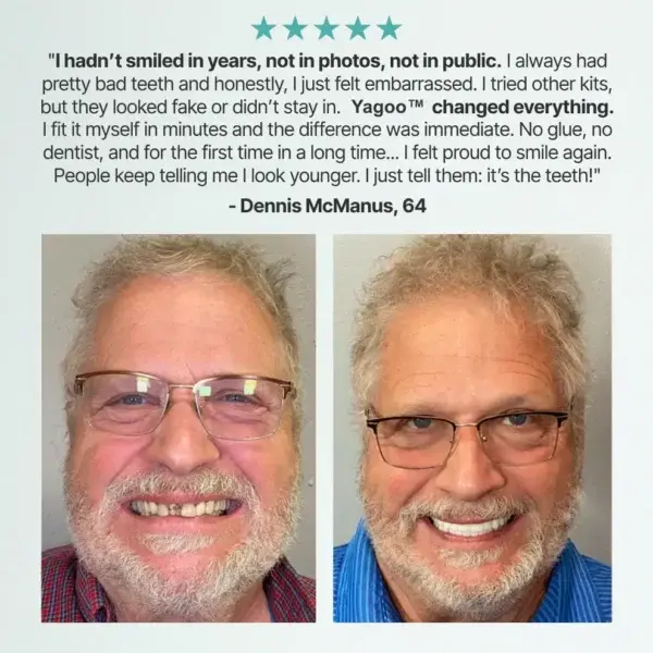 Custom Custom-Fit Full Functional Dentures - Image 6