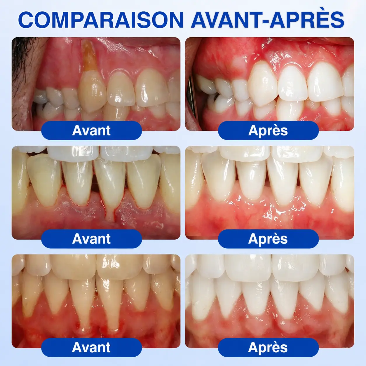 🦷 𝑮𝒖𝒎𝑹𝒆𝒗𝒊𝒗𝒆 𝑮𝒆𝒍 𝒅𝒆 𝑹é𝒑𝒂𝒓𝒂𝒕𝒊𝒐𝒏 𝑷𝒂𝒓𝒐𝒅𝒐𝒏𝒕𝒂𝒍𝒆 - Image 3